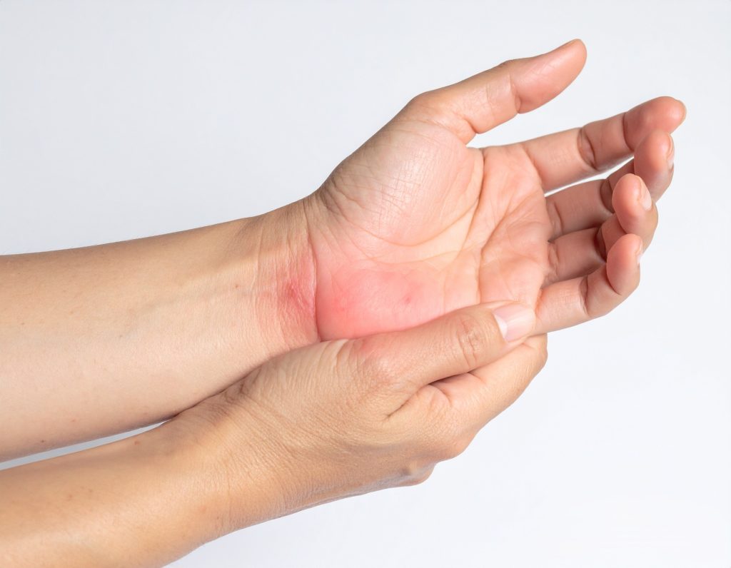 Medical illustration of hand anatomy showing carpal tunnel syndrome with median nerve compression