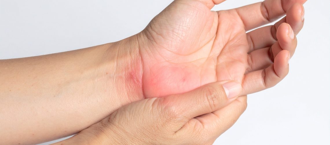 symptoms-of-carpal-tunnel-syndrome-hand.jpg